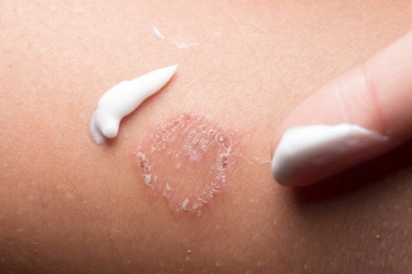 Tratamento com miconazol