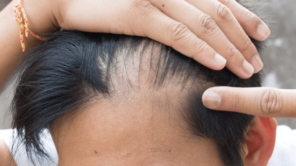 Tratamento natural para calvície